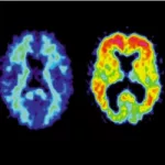 Alzheimermiddel solanezumab blijkt niet effectief