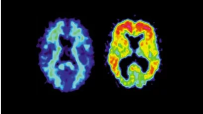 Alzheimermiddel solanezumab blijkt niet effectief