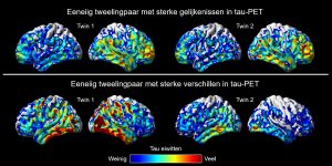 Publicatie: Hoe gelijk zijn eeneiige tweelingen in hoeveelheid en locatie van tau eiwit stapeling in de hersenen?