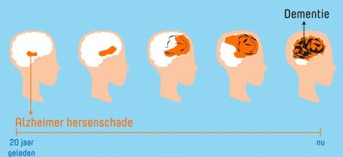 Het verschil tussen alzheimer en dementie