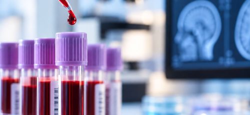 Bloedtest krijgt steeds grotere rol in diagnose en behandeling van alzheimer